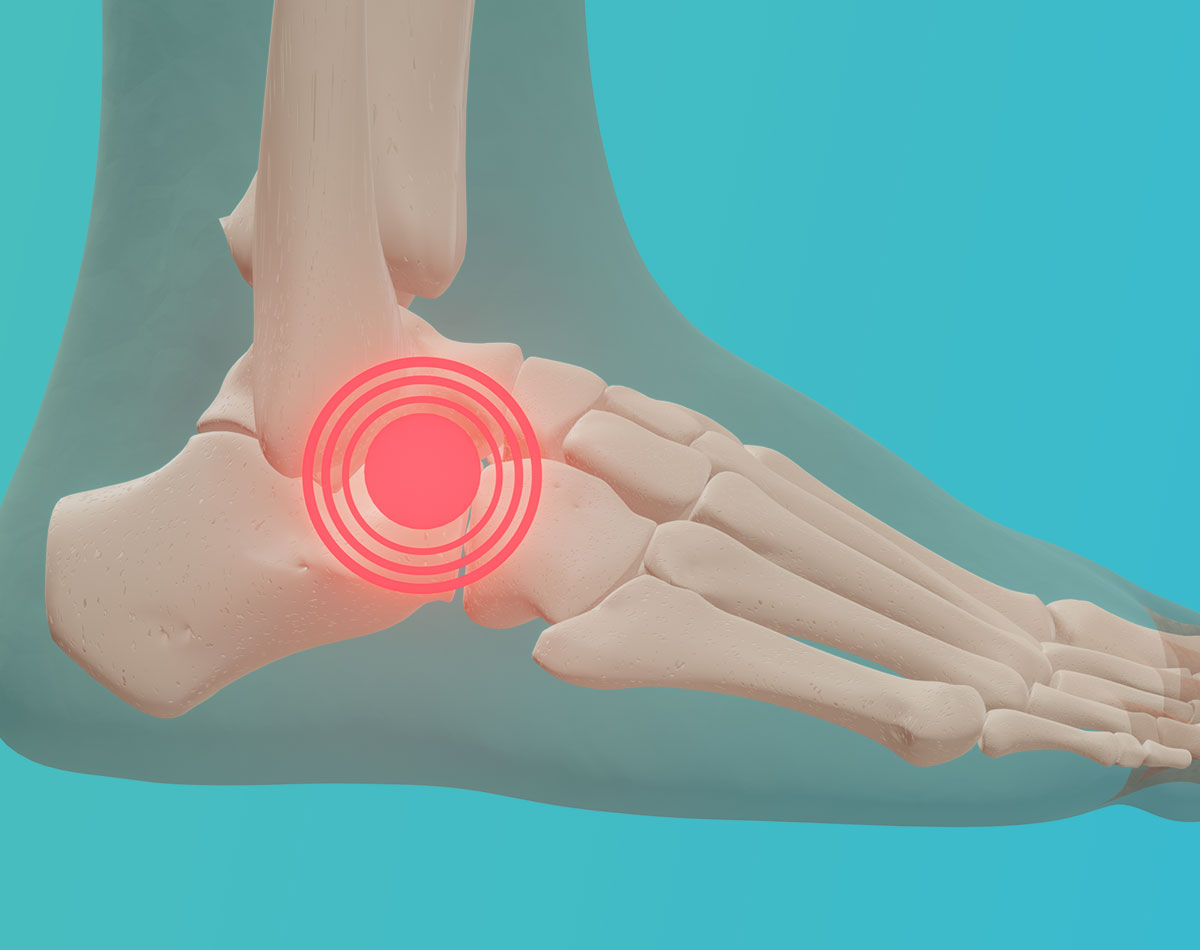 Ankle-Pain